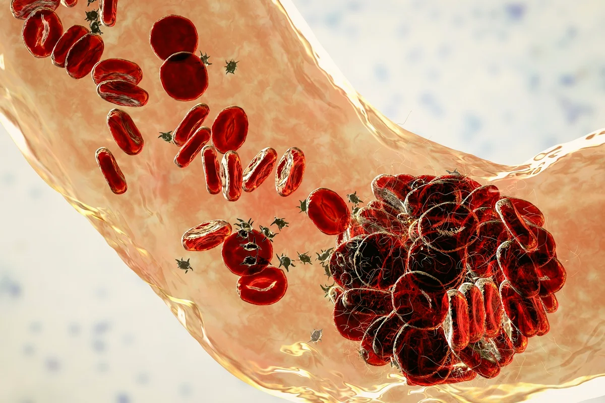 Médico vascular aponta fatores de risco e o que ajuda a prevenir a trombose