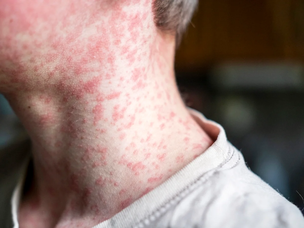 Mortes por sarampo nos EUA acendem alerta com alta de casos no Brasil